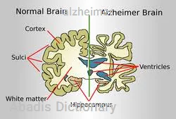 alzheimer