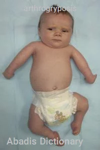 arthrogryposis