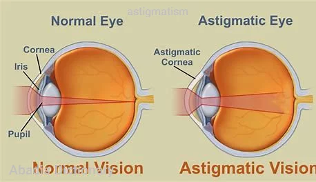 astigmatism