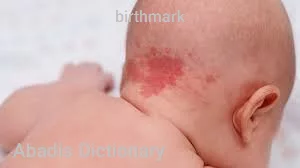 birthmark