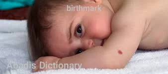 birthmark