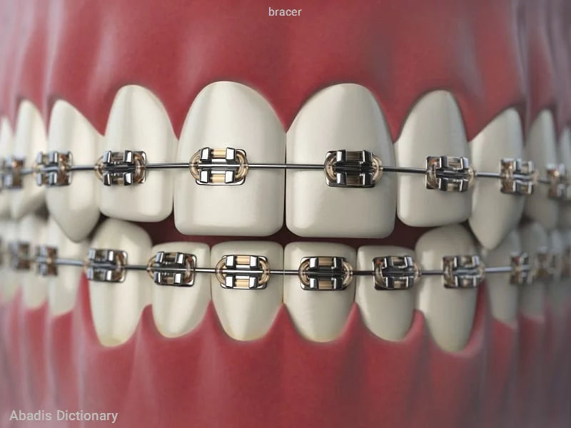 bracer