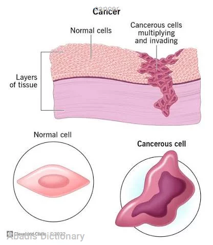 cancer