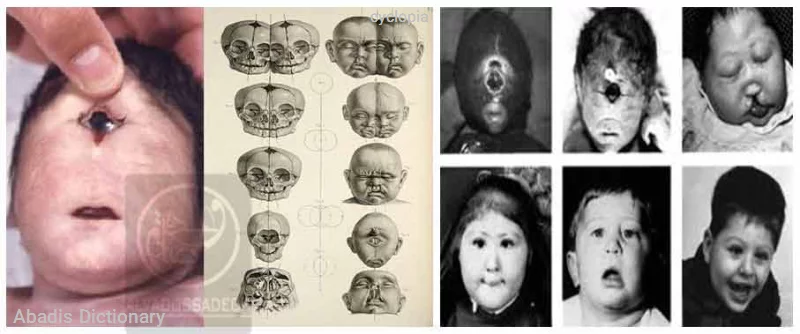 cyclopia