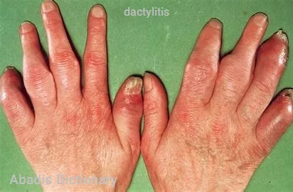 dactylitis