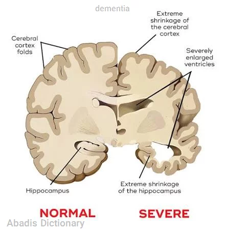 dementia