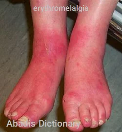 erythromelalgia