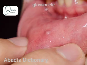 glossocele