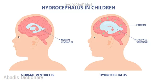 hydrocephalus