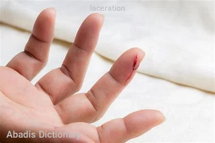 laceration