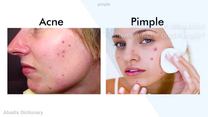 pimple