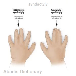 syndactyly