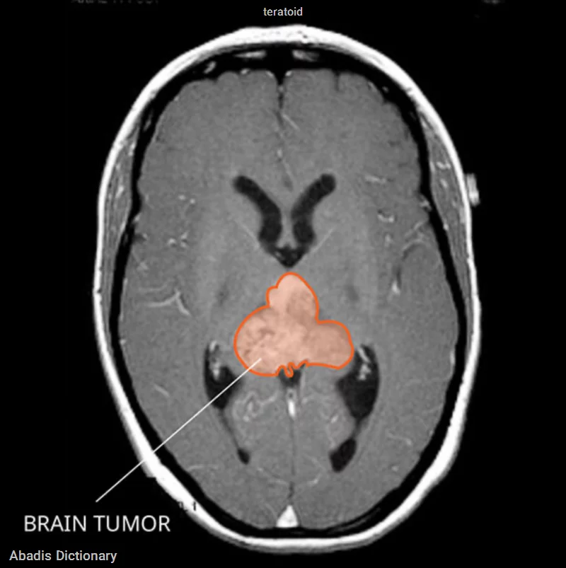 teratoid