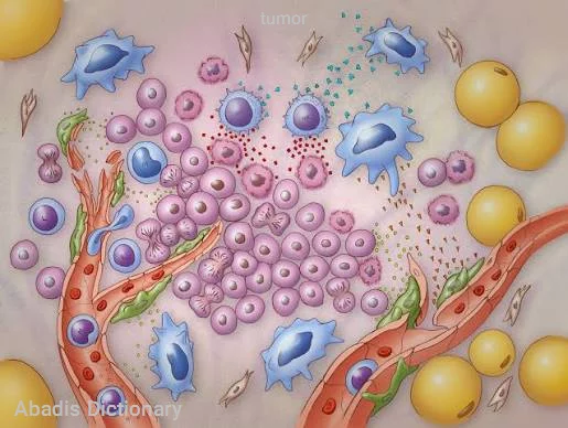 tumor