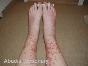 vasculitis