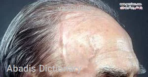 vasculitis