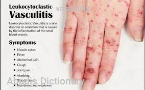 vasculitis