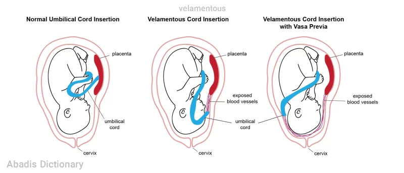 velamentous