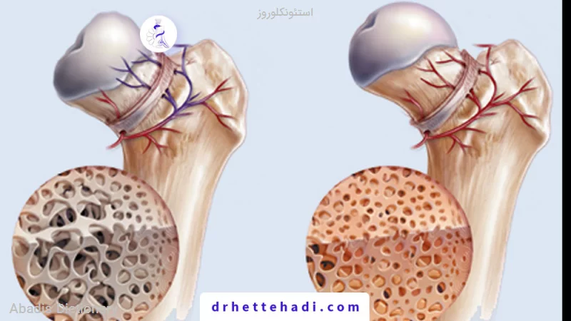 استئونکلوروز