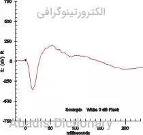 الکترورتینوگرافی