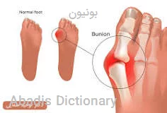 بونیون