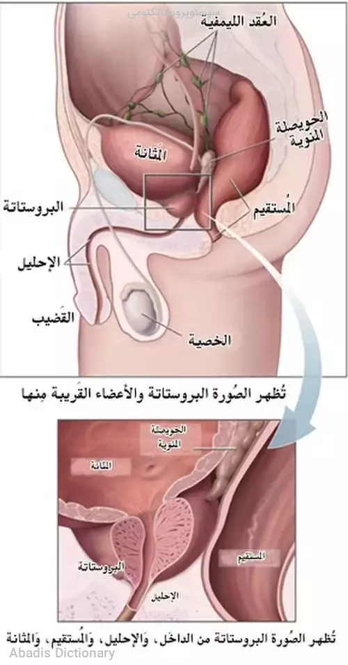 سیستوپروستاتکتومی