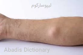 لیپوسارکوم