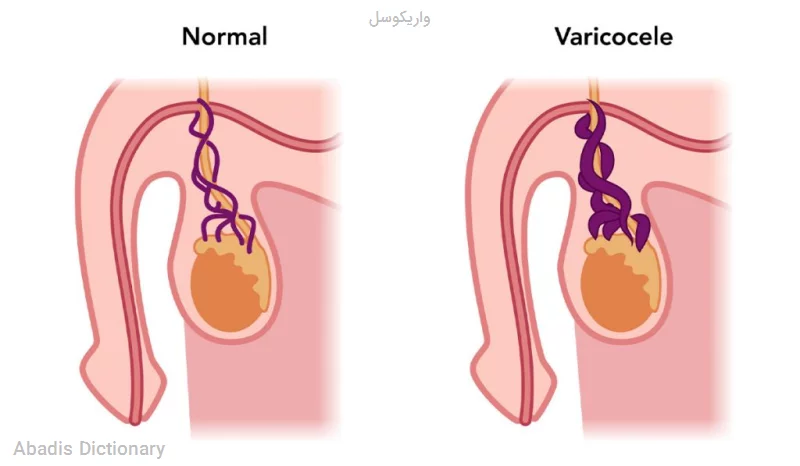 واریکوسل