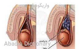 واریکوسل