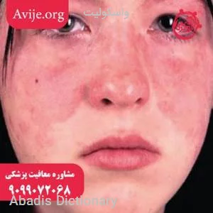 واسکولیت