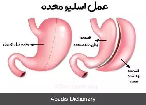 عکس گاسترکتومی آستینی