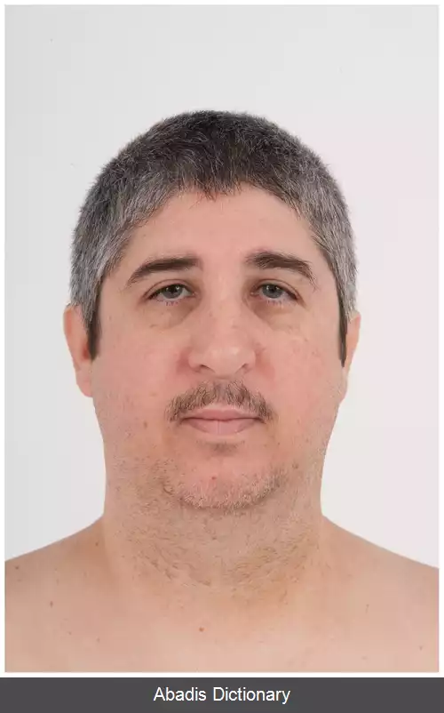 عکس سندرم دوبوویتز
