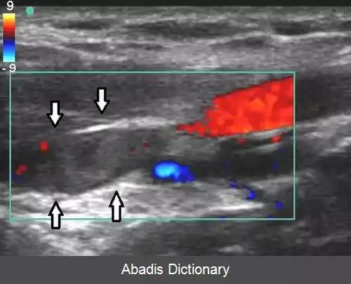 عکس سونوگرافی فراصوتی داپلر