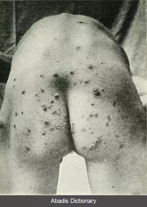 عکس پیودرما