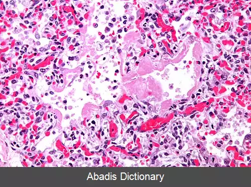 عکس تخریب گسترده آلوئولی