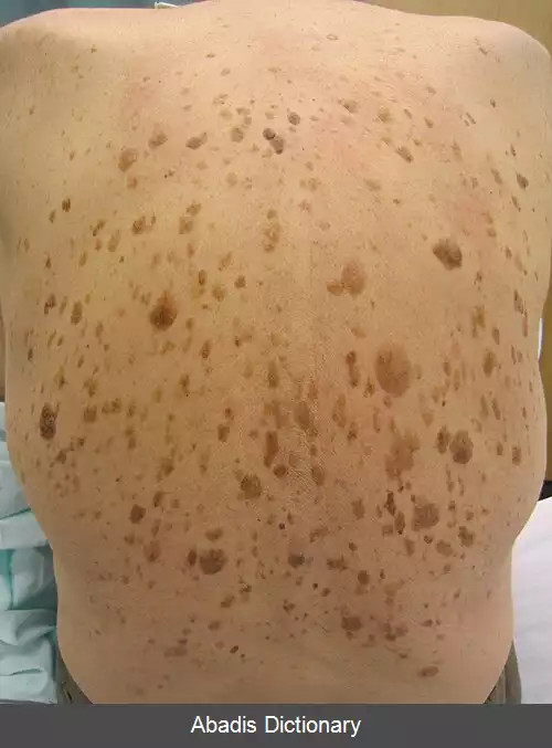 عکس کراتوز سبورئیک