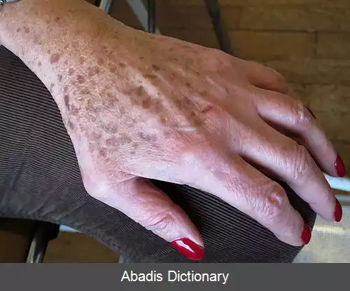 عکس لنتیگو