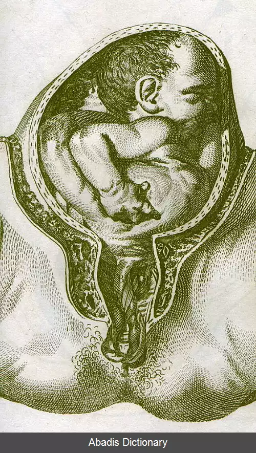 عکس فروافتادگی بند ناف