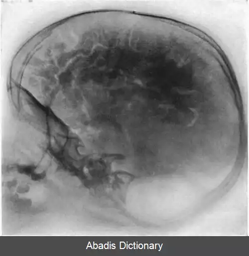 عکس پنوموآنسفالوگرافی