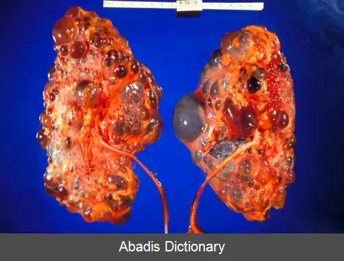 عکس بیماری کلیه پلی کیستیک