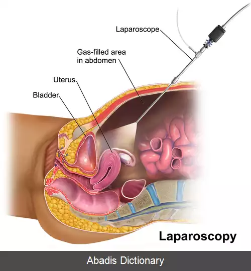 عکس جراحی با لاپاراسکوپ