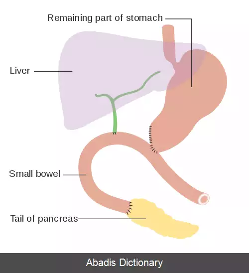 عکس پانکراتیکودئودنکتومی