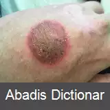 عکس سوختگی آئروسل