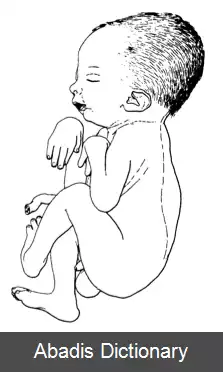عکس خمیدگی مفاصل