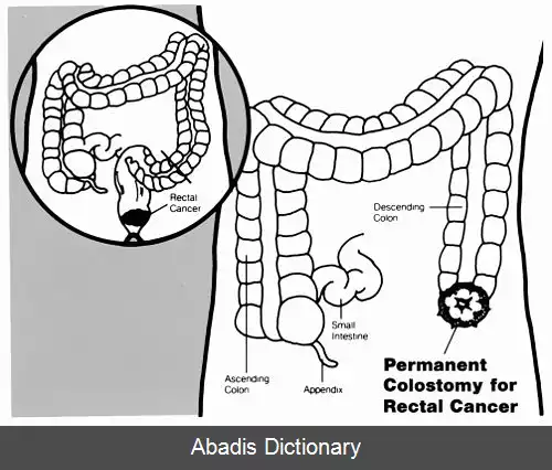 عکس کولوستومی