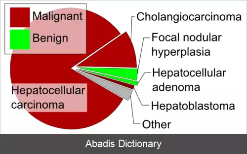 عکس کارسینوم هپاتوسلولار