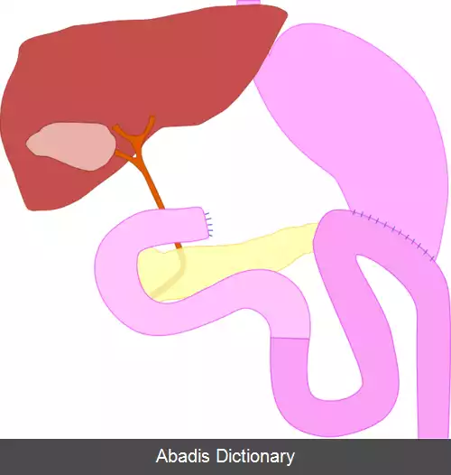 عکس گاسترکتومی