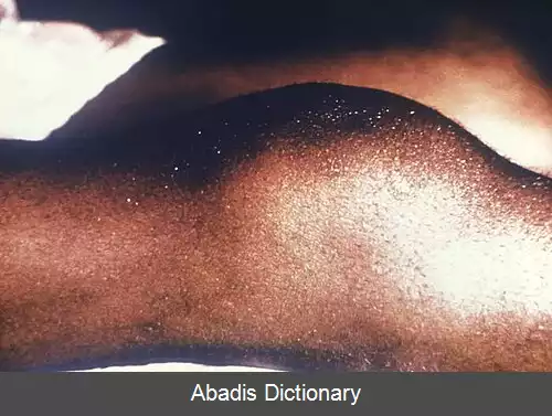 عکس مفاصل کلاتون