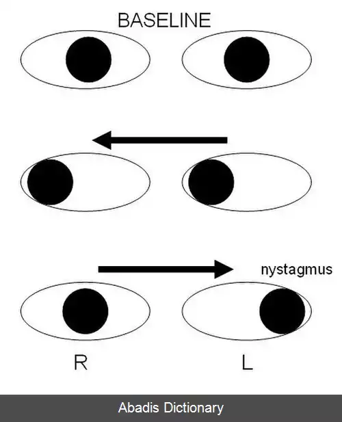 عکس فلج چشمی بین هسته ای