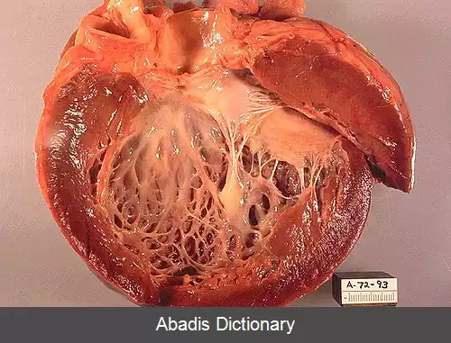 عکس بیماری ماهیچه قلب